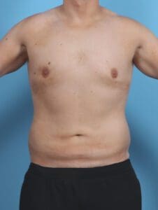 Male Body Lift - Case 46469 - Before