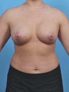 Breast Augmentation - Case 46537 - After