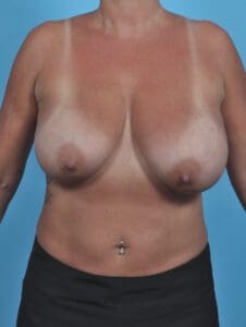 Breast Lift/Reduction w/o Implants - Case 46577 - Before