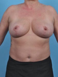 Breast Lift/Reduction w/o Implants - Case 46577 - After