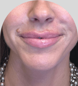 Lip Fillers - Case 46616 - Before