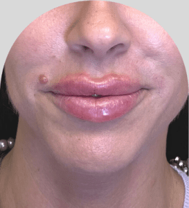 Lip Fillers - Case 46616 - After