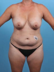 Breast Lift/Reduction with Implants - Case 46713 - Before