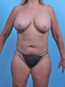Breast Lift/Reduction with Implants - Case 46851 - Before