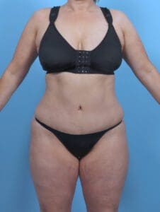 Tummy Tuck - Case 46902 - After
