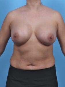 Breast Augmentation - Case 46913 - After