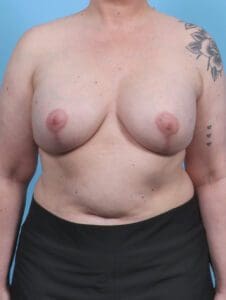 Breast Implant Revision - Case 46947 - After