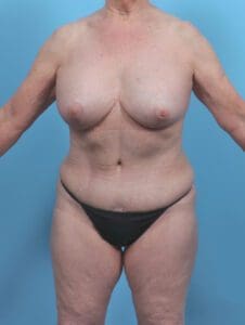Breast Lift/Reduction with Implants - Case 46993 - After