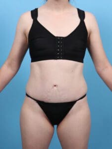 Tummy Tuck - Case 47192 - After