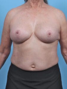 Breast Augmentation - Case 47200 - After