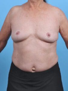 Breast Augmentation - Case 47200 - Before