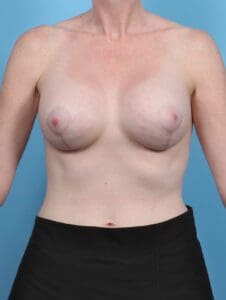 Breast Lift/Reduction with Implants - Case 47261 - After