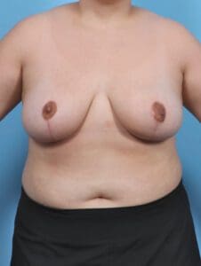 Breast Lift/Reduction w/o Implants - Case 47286 - After
