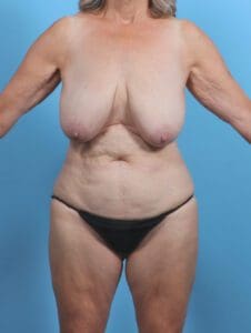 Breast Lift/Reduction w/o Implants - Case 47312 - Before