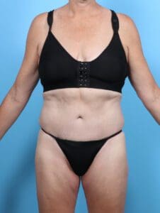 Tummy Tuck - Case 47322 - After
