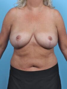 Breast Implant Removal - Case 47354 - After