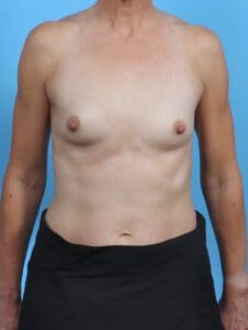 Breast Augmentation - Case 47396 - Before