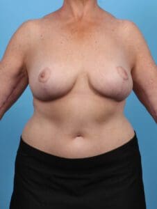 Breast Lift/Reduction w/o Implants - Case 47434 - After