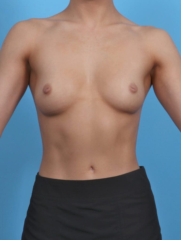 Breast Augmentation - Case 47436 - Before