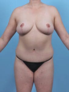 Breast Lift/Reduction w/o Implants - Case 47552 - After