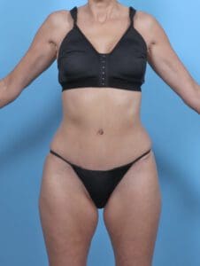 Tummy Tuck - Case 47620 - After