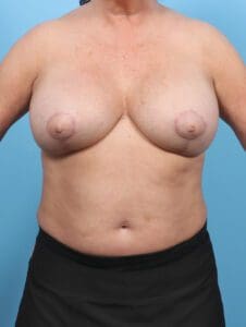 Breast Implant Revision - Case 47652 - After