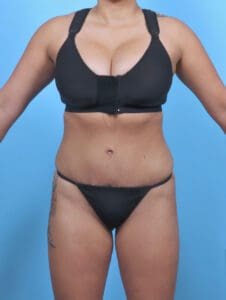 Tummy Tuck - Case 47685 - After