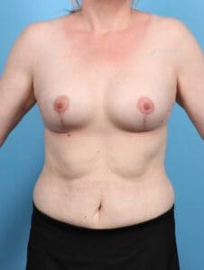 Breast Lift/Reduction with Implants - Case 47755 - After