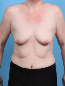 Breast Lift/Reduction with Implants - Case 47755 - Before