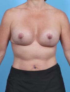 Breast Implant Revision - Case 47781 - After