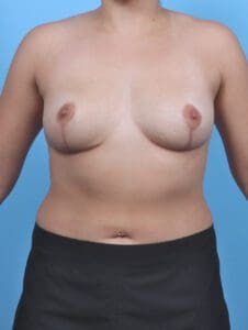 Breast Implant Removal - Case 47813 - After