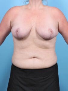 Breast Lift/Reduction w/o Implants - Case 47871 - After