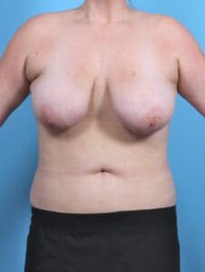 Breast Lift/Reduction w/o Implants - Case 47871 - Before