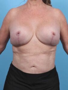 Breast Implant Revision - Case 47897 - After