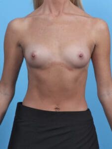 Breast Augmentation - Case 48051 - Before