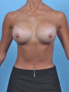 Breast Augmentation - Case 48051 - After