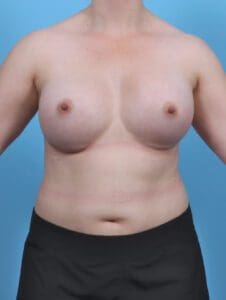 Breast Augmentation - Case 48060 - After