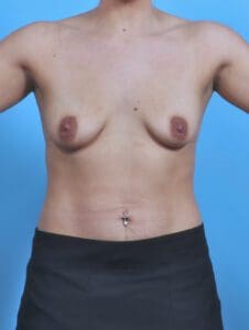 Breast Lift/Reduction with Implants - Case 48094 - Before