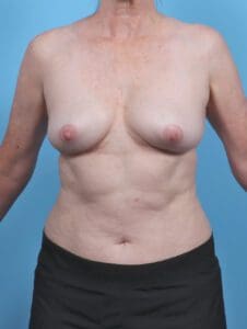 Breast Implant Removal - Case 48102 - After