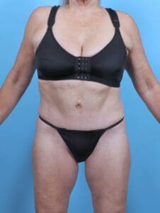 Tummy Tuck - Case 48126 - After