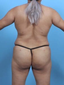 Liposuction - Case 48152 - After
