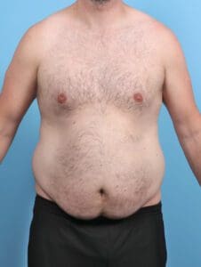 Male Tummy Tuck - Case 48162 - Before