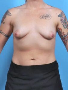 Breast Lift/Reduction with Implants - Case 48198 - Before