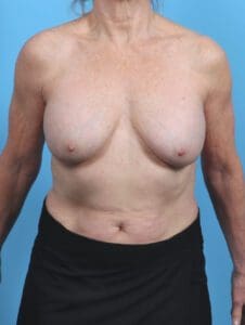 Breast Implant Removal - Case 48249 - Before