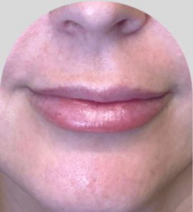 Lip Fillers - Case 48313 - Before