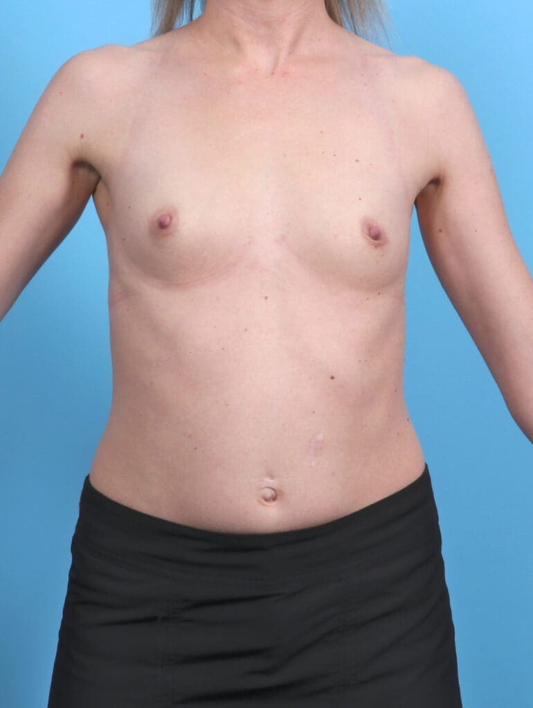 Breast Augmentation - Case 50852 - Before