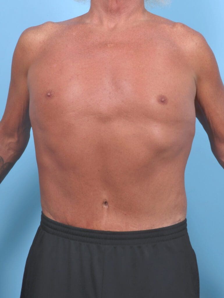 Male Body Lift - Case 51086 - After
