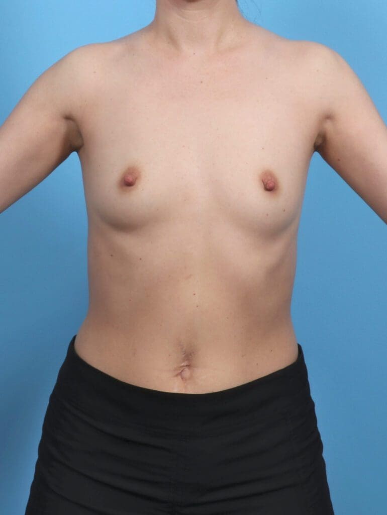 Breast Augmentation - Case 51485 - Before