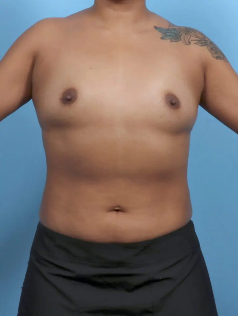 Breast Augmentation - Case 51501 - Before