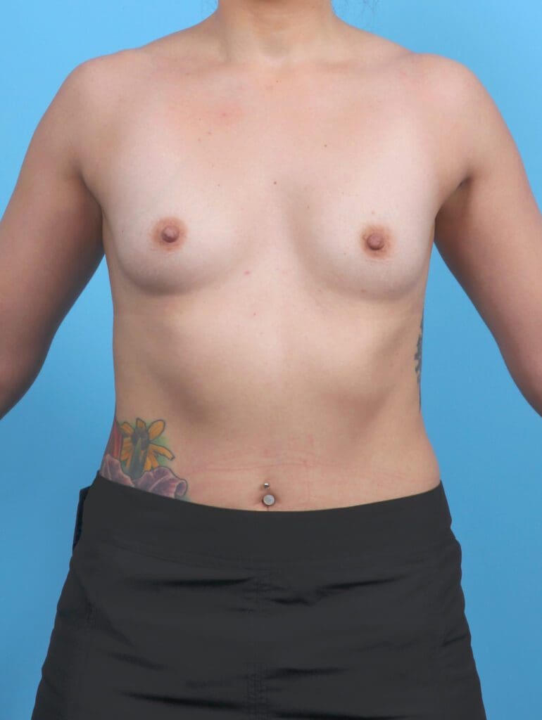 Breast Augmentation - Case 51682 - Before